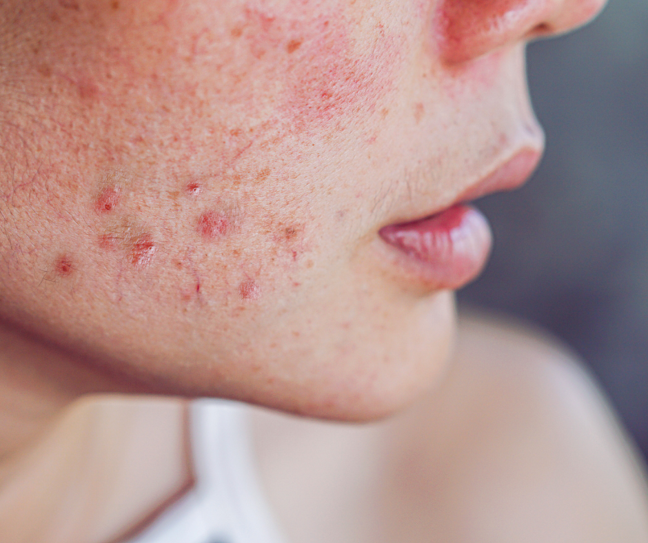 Common Skin Disorders Linked to Skin Microbiome Imbalance