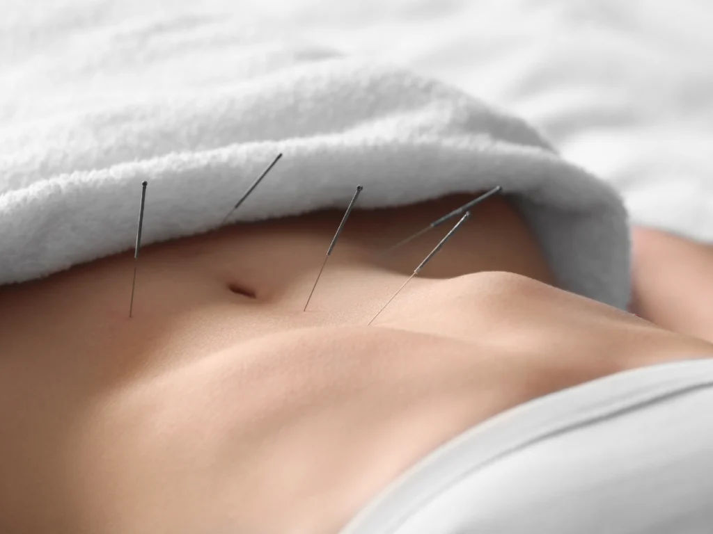 Naturopathy and Acupuncture During IVF Treatment